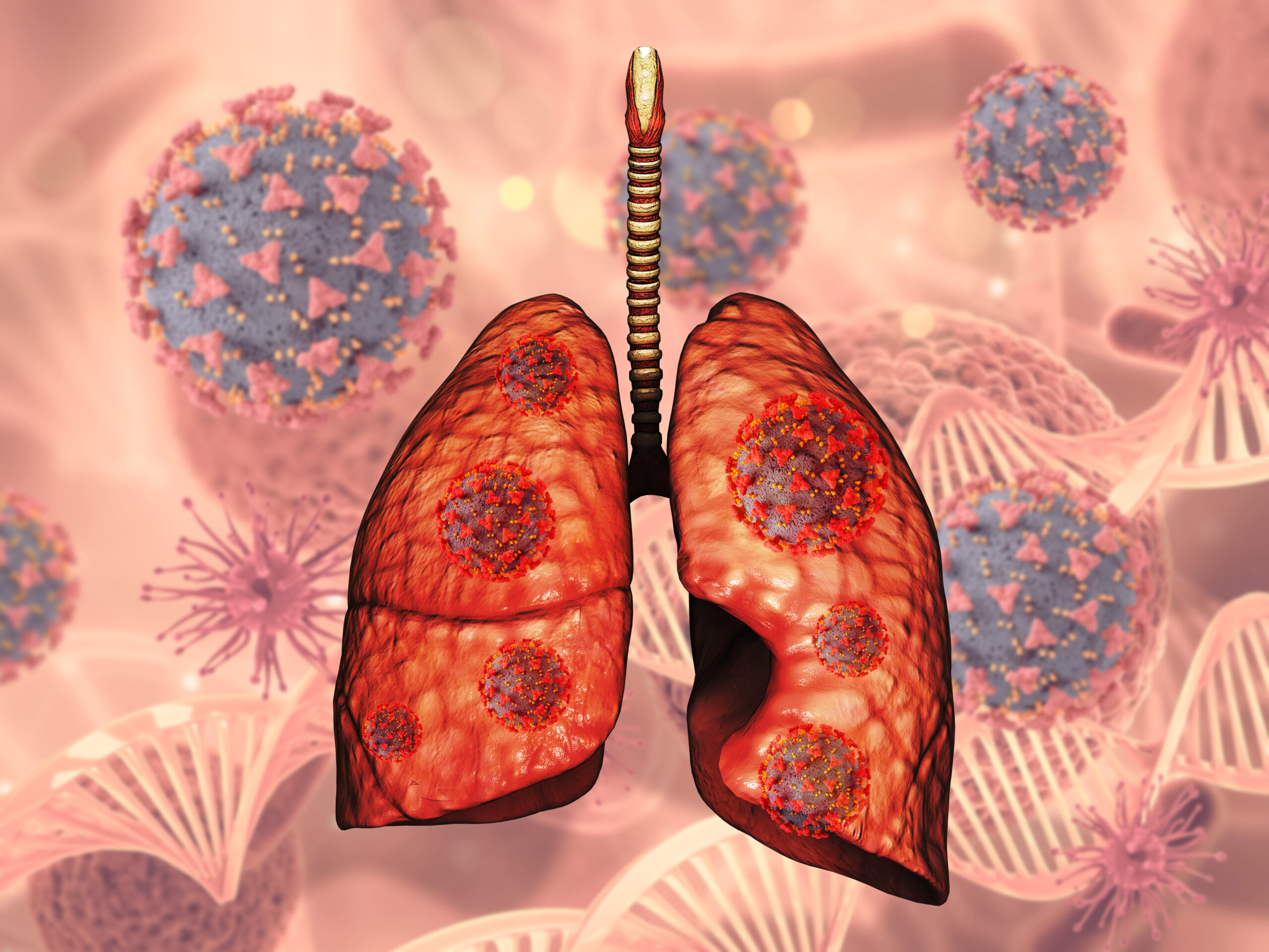 Exudative Pleural Effusion