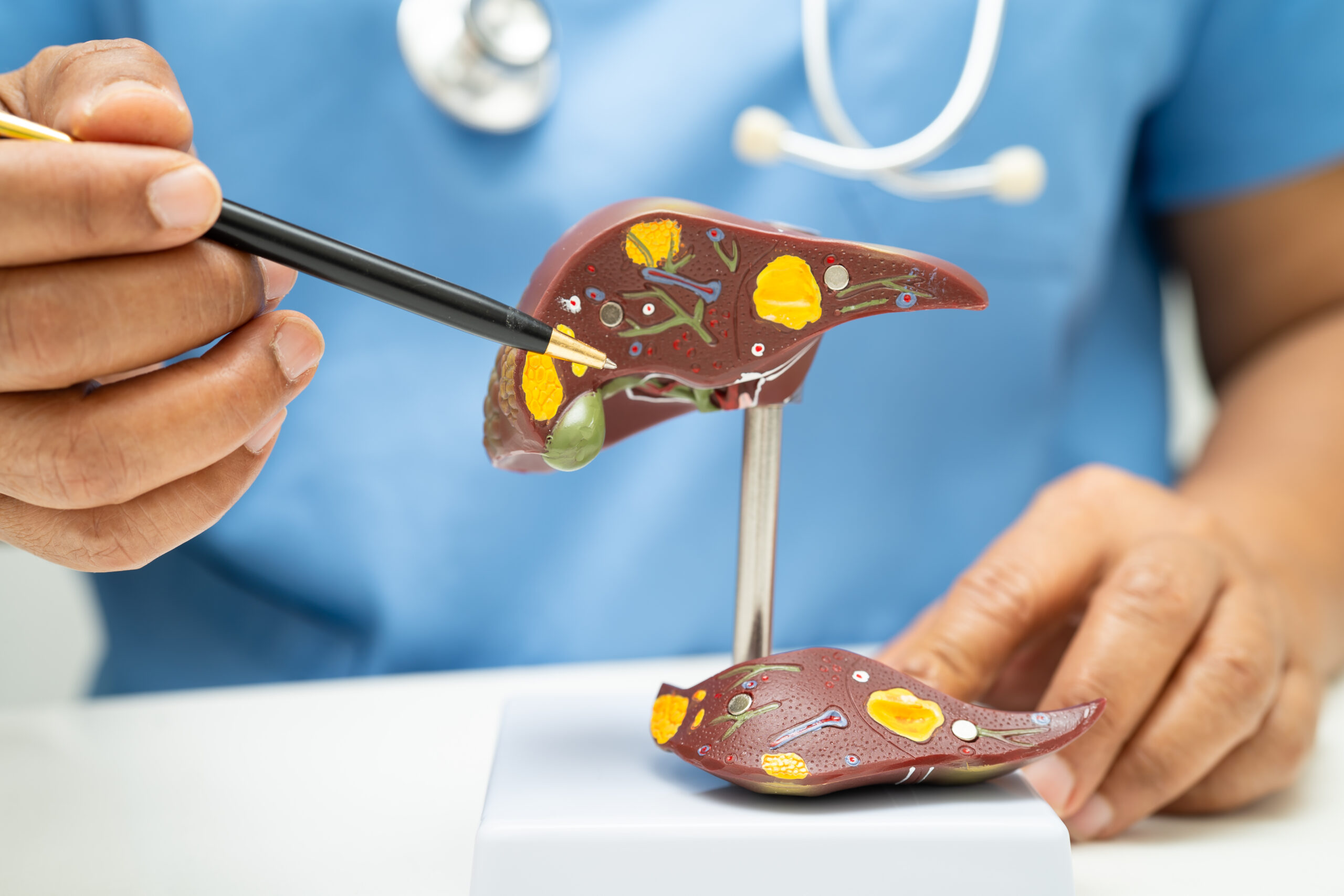 Cirrhosis, Liver cancer, fatty liver, Asian doctor with liver human anatomy model in World Hepatitis Day at hospital.