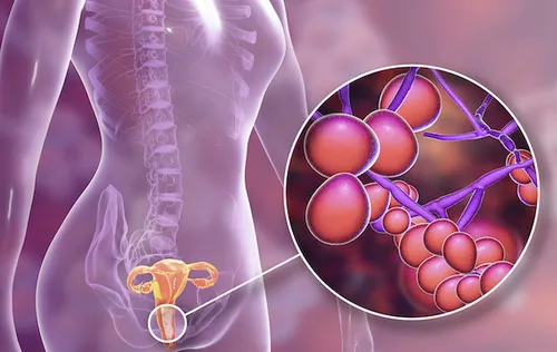 Vaginal Infection During Pregnancy: Treatment & Prevention