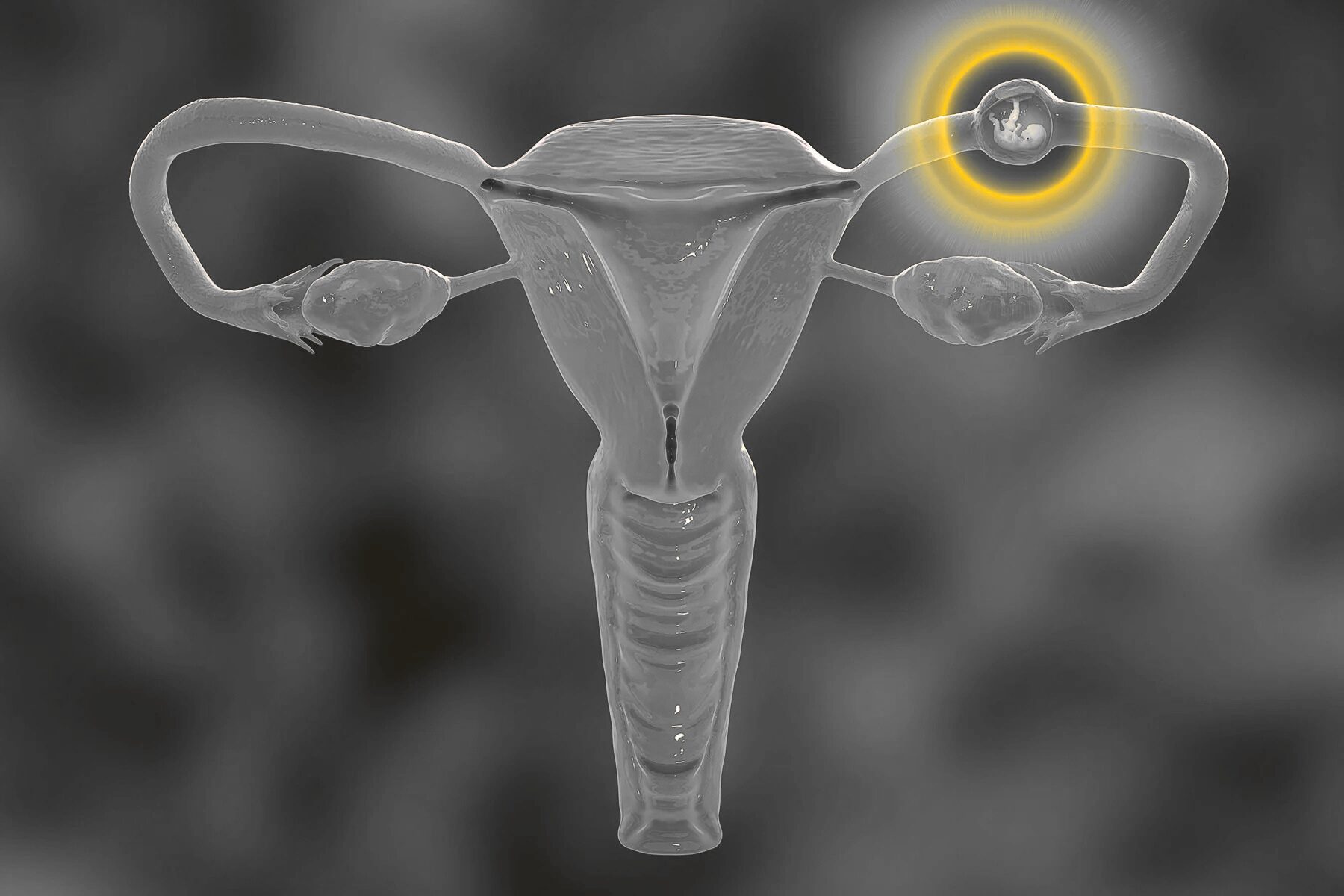 Ruptured Ectopic Pregnancy