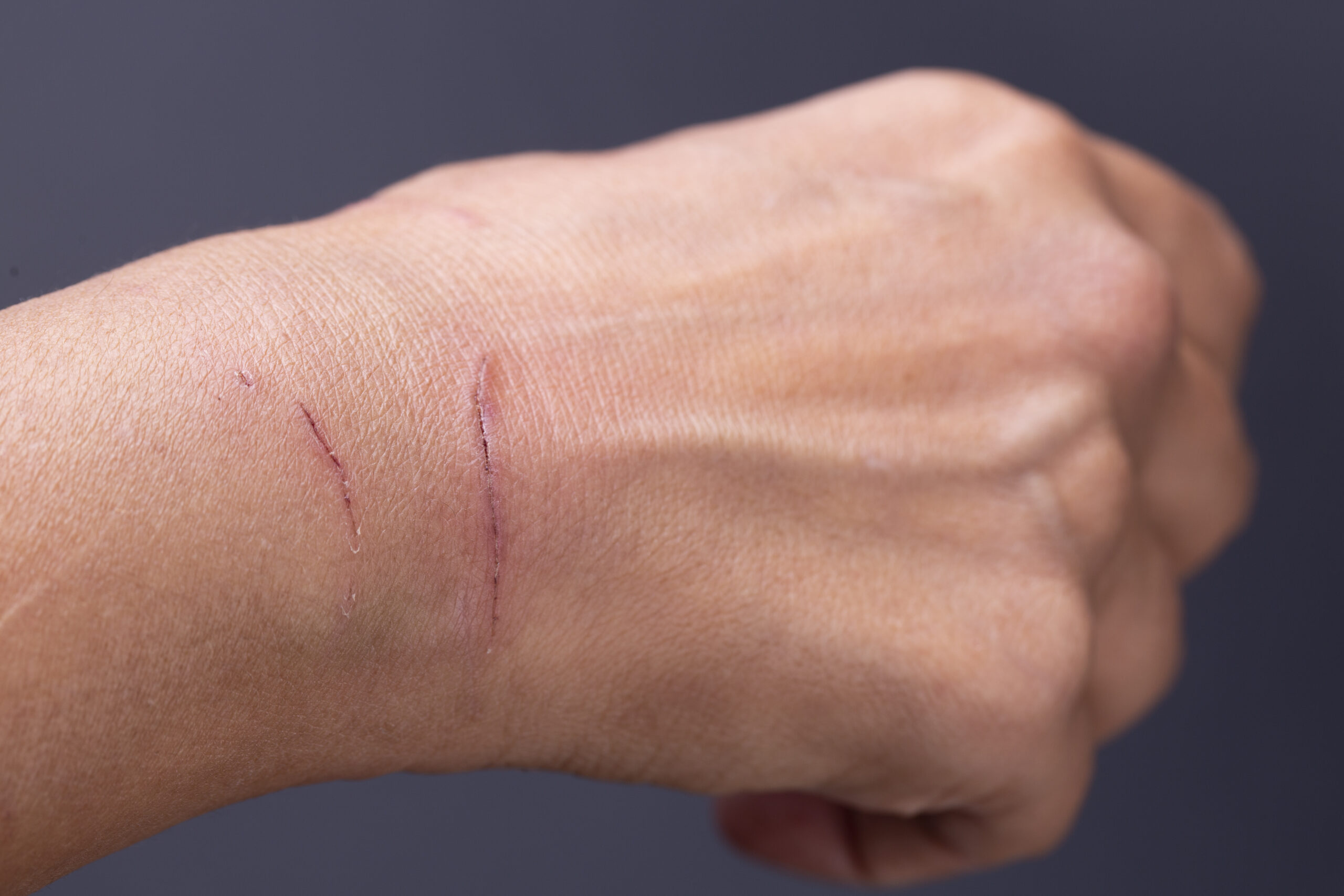 Laceration Injury on Skin