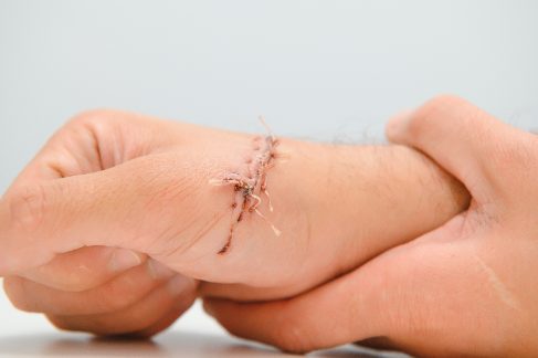 Deep Split Laceration