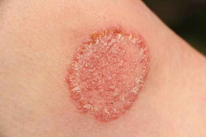 How to Cure Fungal Infection on Skin Naturally at Home Fast