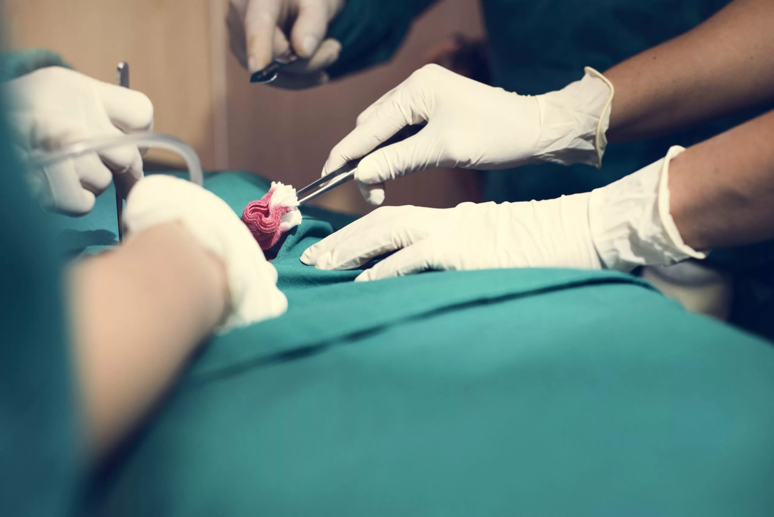 Stapler Surgery for Piles