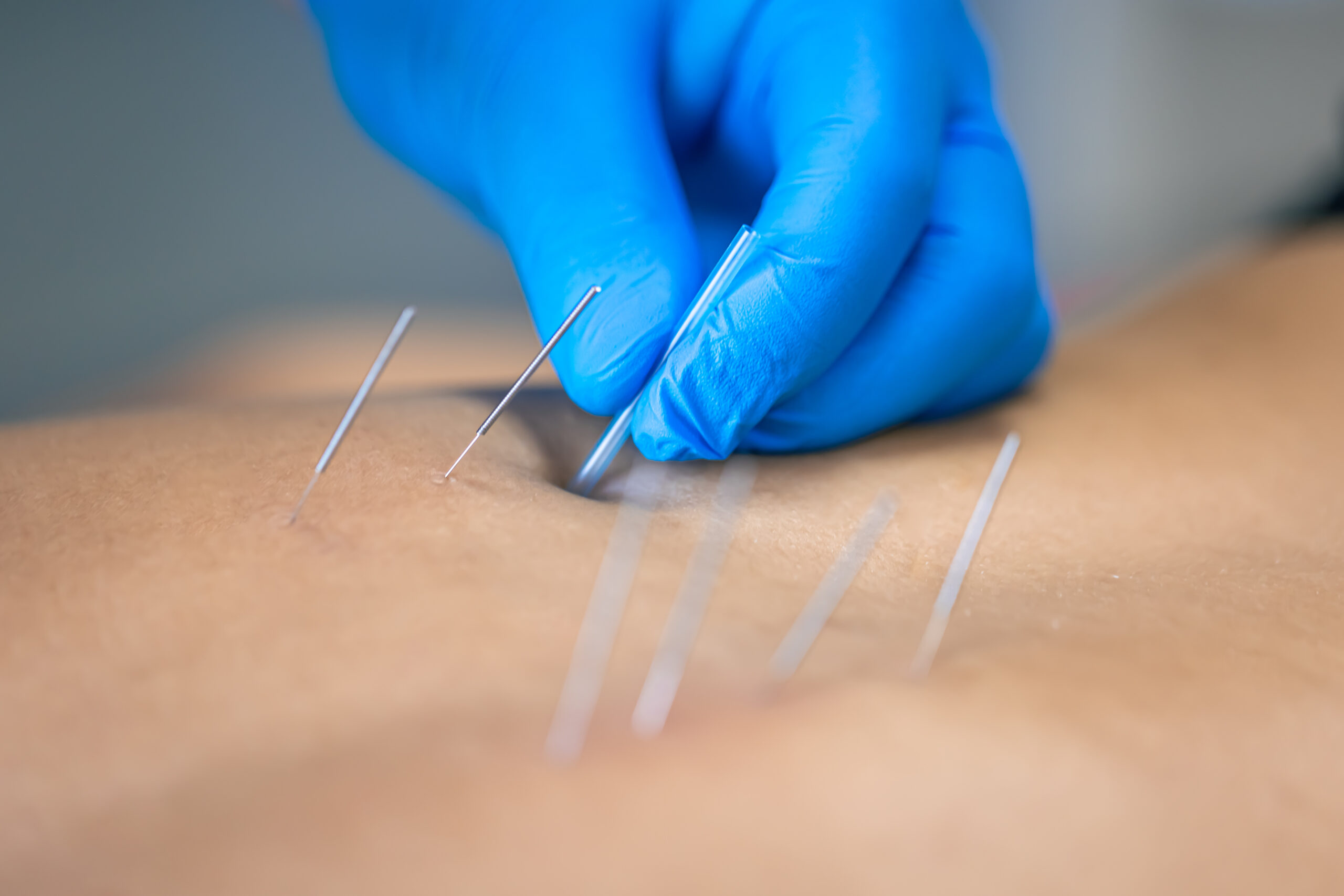 Dry Needling Physiotherapy