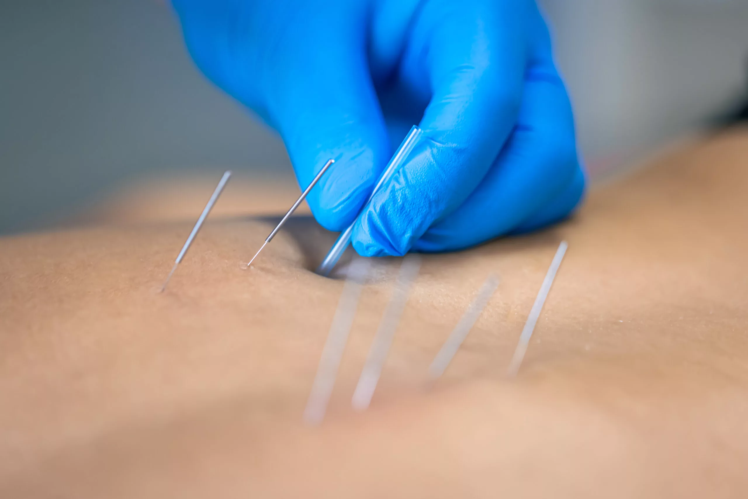 Dry Needling Physiotherapy