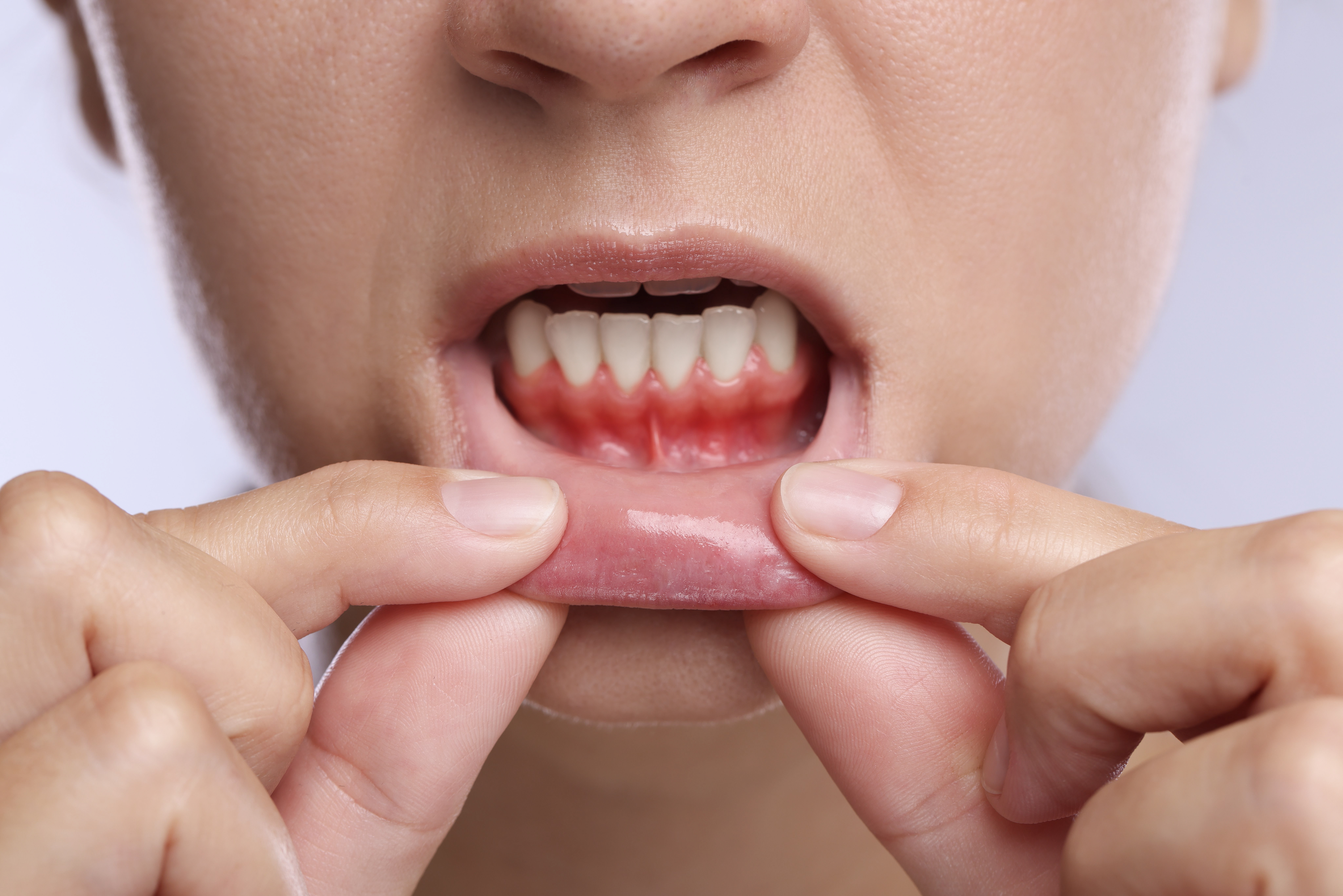 Reason for Swollen Gums