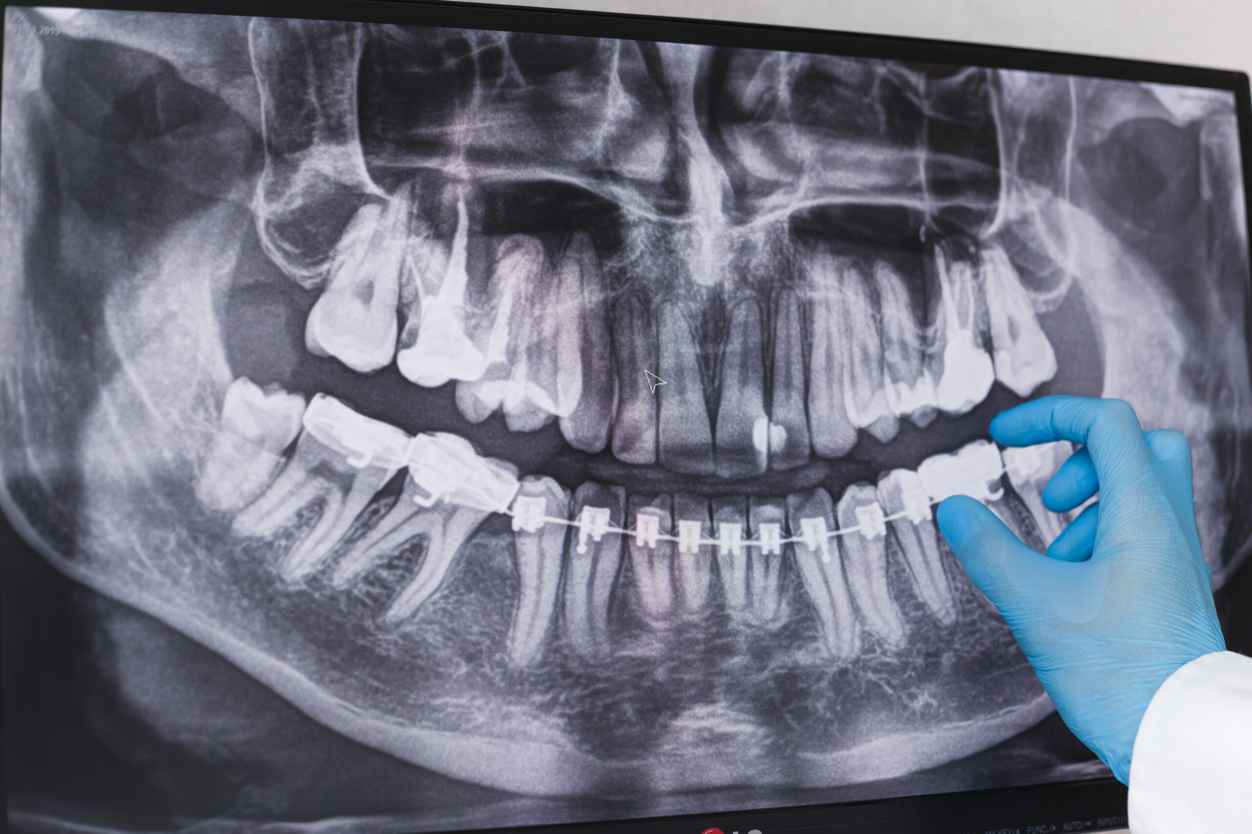 Doctor points to braces in dental x-ray.
